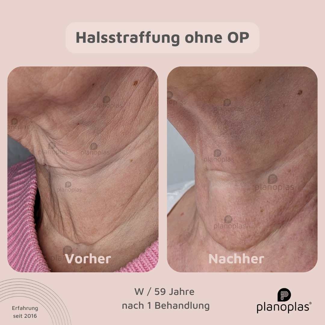 Vorher-Nachher planoplas® Plasma Pen Behandlung Halsstraffung