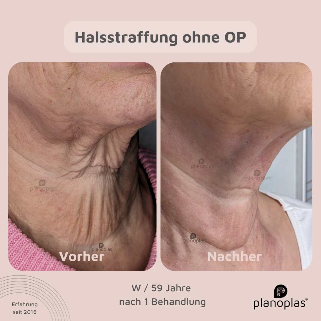 Vorher-Nachher planoplas® Plasma Pen Behandlung Halsstraffung