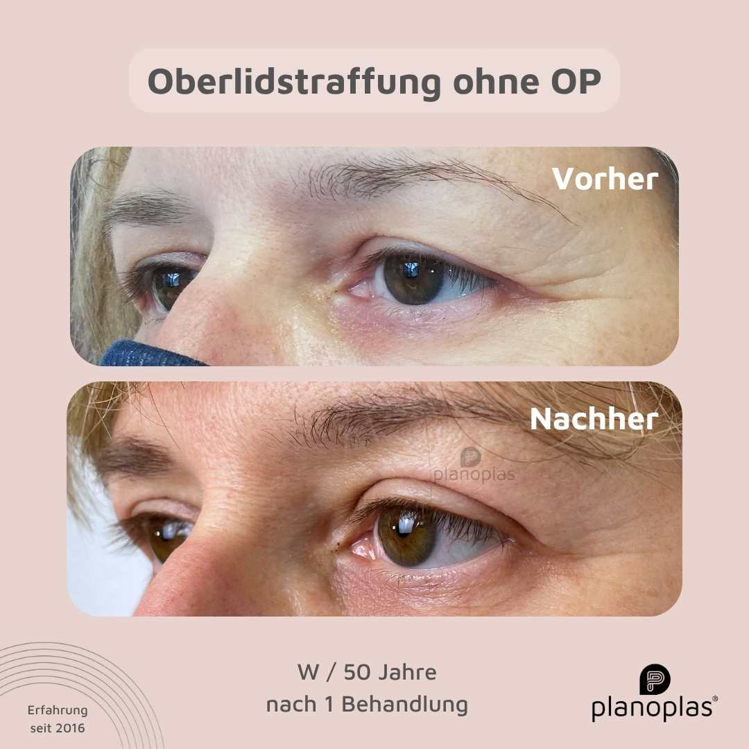 planoplas® Oberlidstraffung Vorher-Nachher Frau