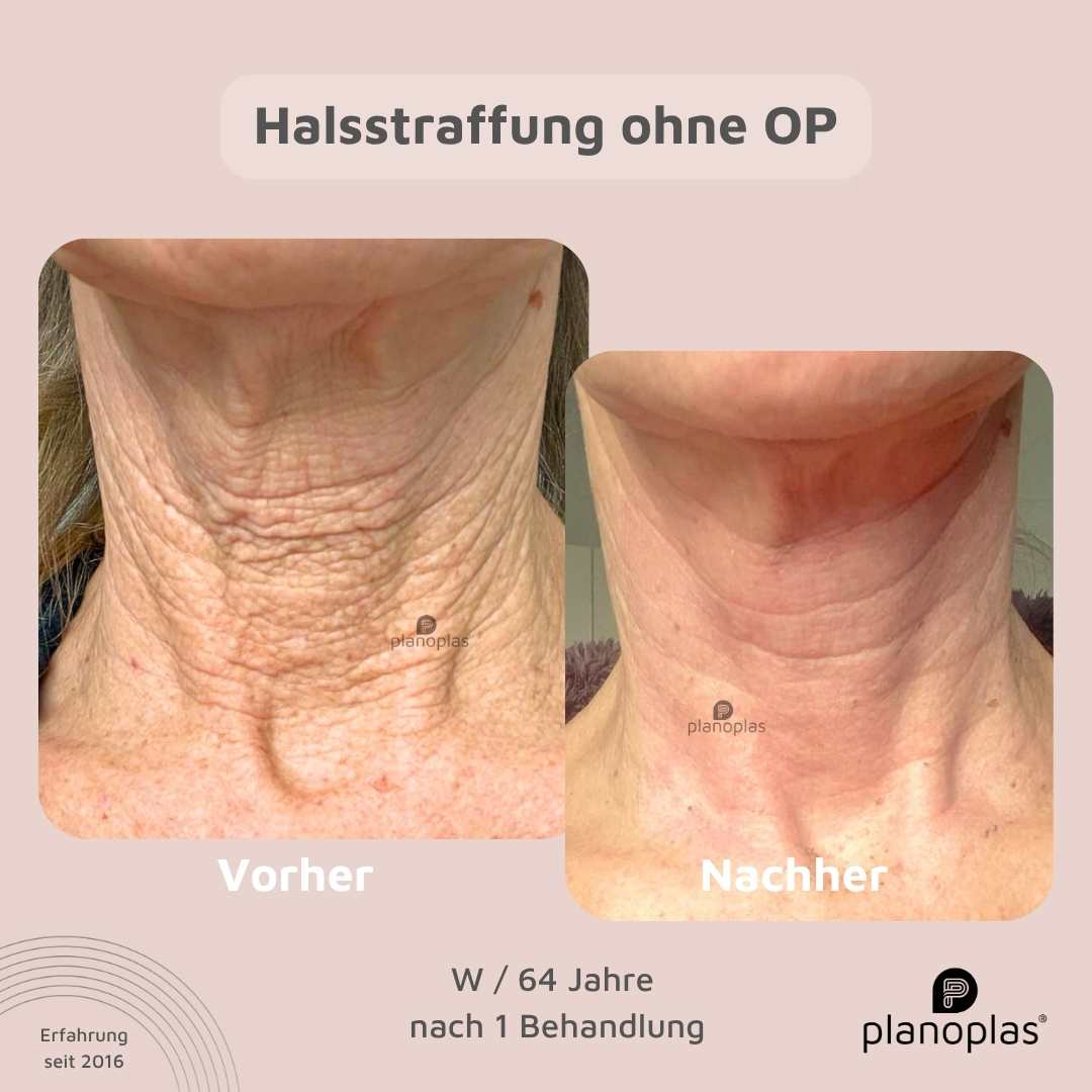 planoplas® Plasma Pen Vorher-Nachher Halsstraffung