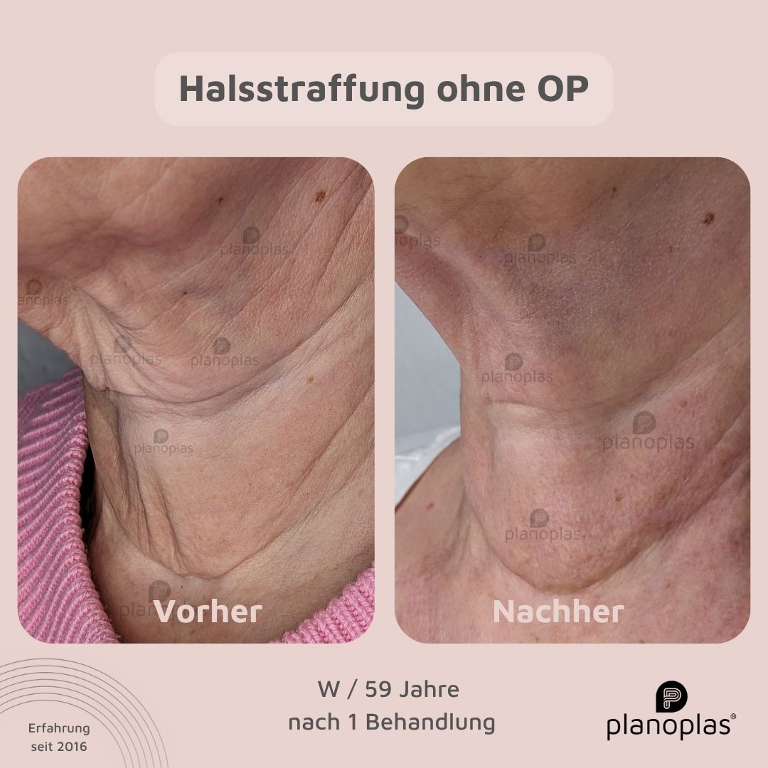 Thermolifting Anti-Aging-Behandlung Hautverjüngung