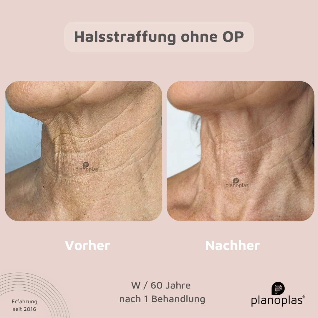 Vorher-Nachher planoplas® Plasma Pen Behandlung Halsstraffung