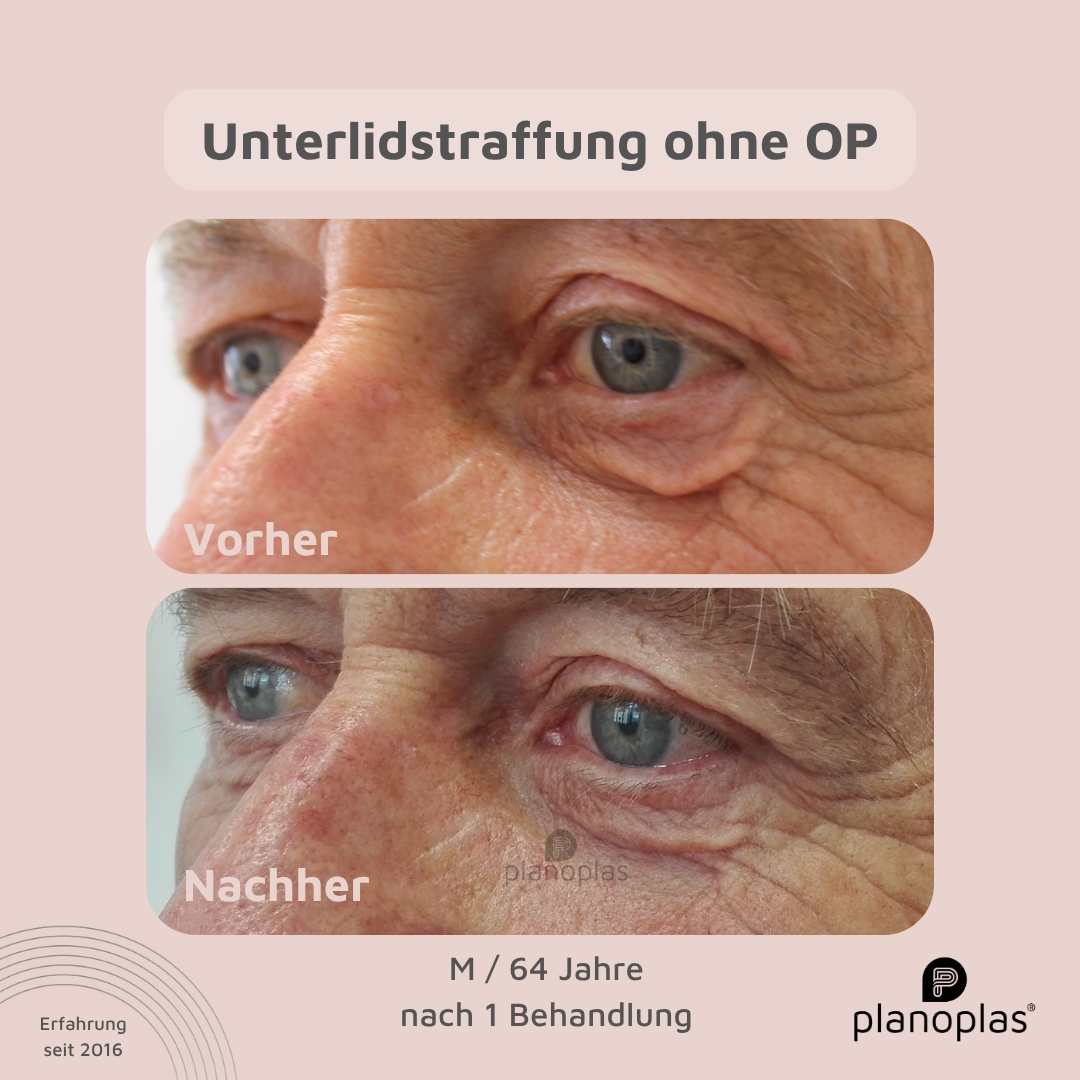 Unterlidstraffung Vorher-Nachher planoplas Plasma Pen Behandlung