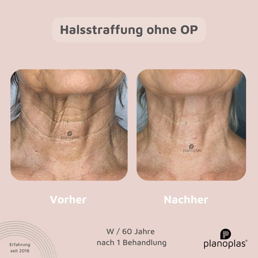 Vorher-Nachher planoplas® Plasma Pen Behandlung Halsstraffung