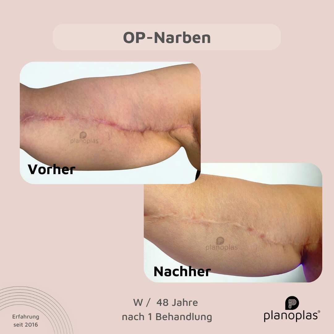 Vorher-Nachher planoplas® Plasma Pen Behandlung Narben