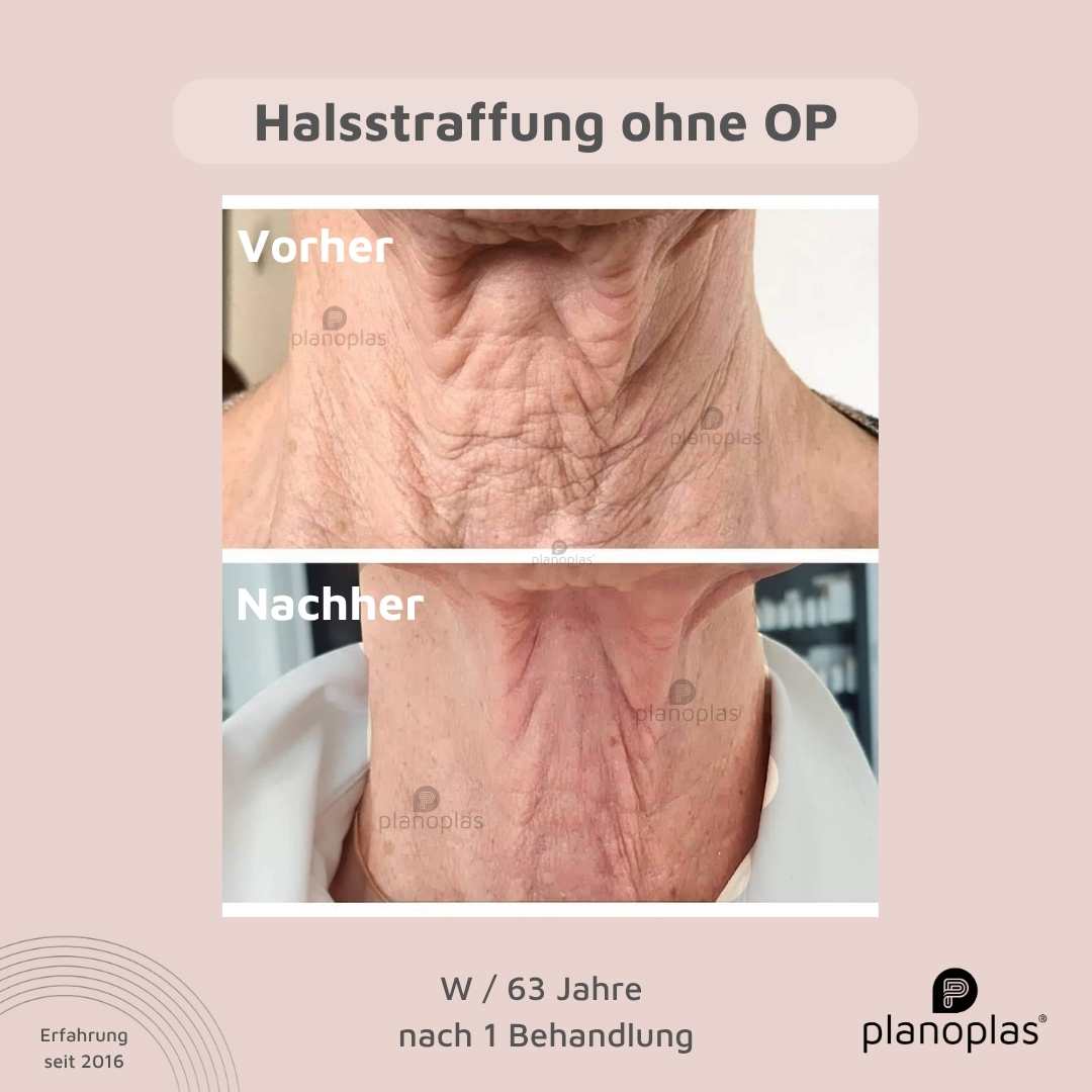Vorher-Nachher planoplas® Plasma Pen Behandlung Halsstraffung
