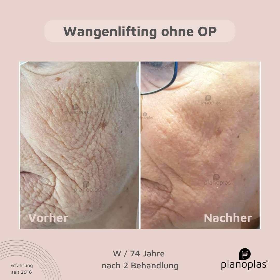 Vorher-Nachher Hautbild planoplas® Plasma Pen