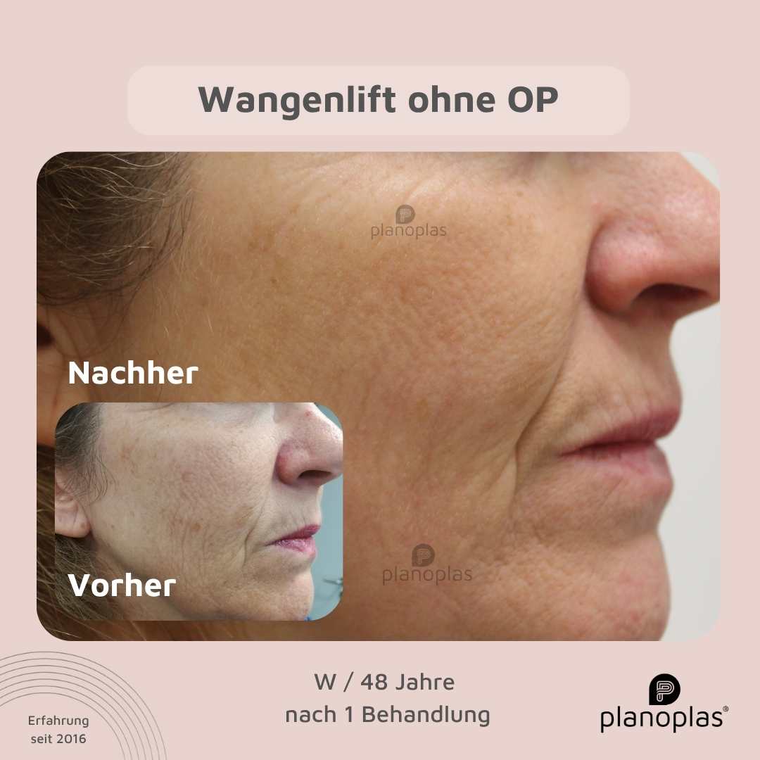 planoplas® Peeling Vorher-Nachher Hautbildverbessserung