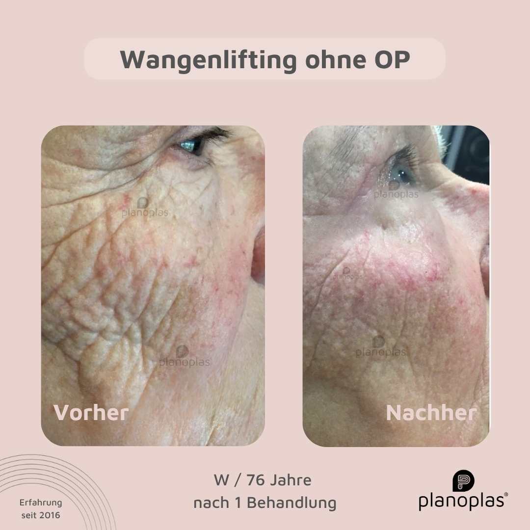 Vorher-Nachher Hautbild planoplas® Plasma Pen