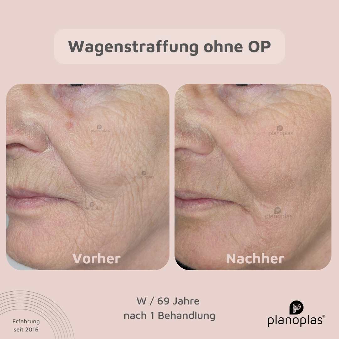 Vorher-Nachher Hautbild planoplas® Plasma Pen