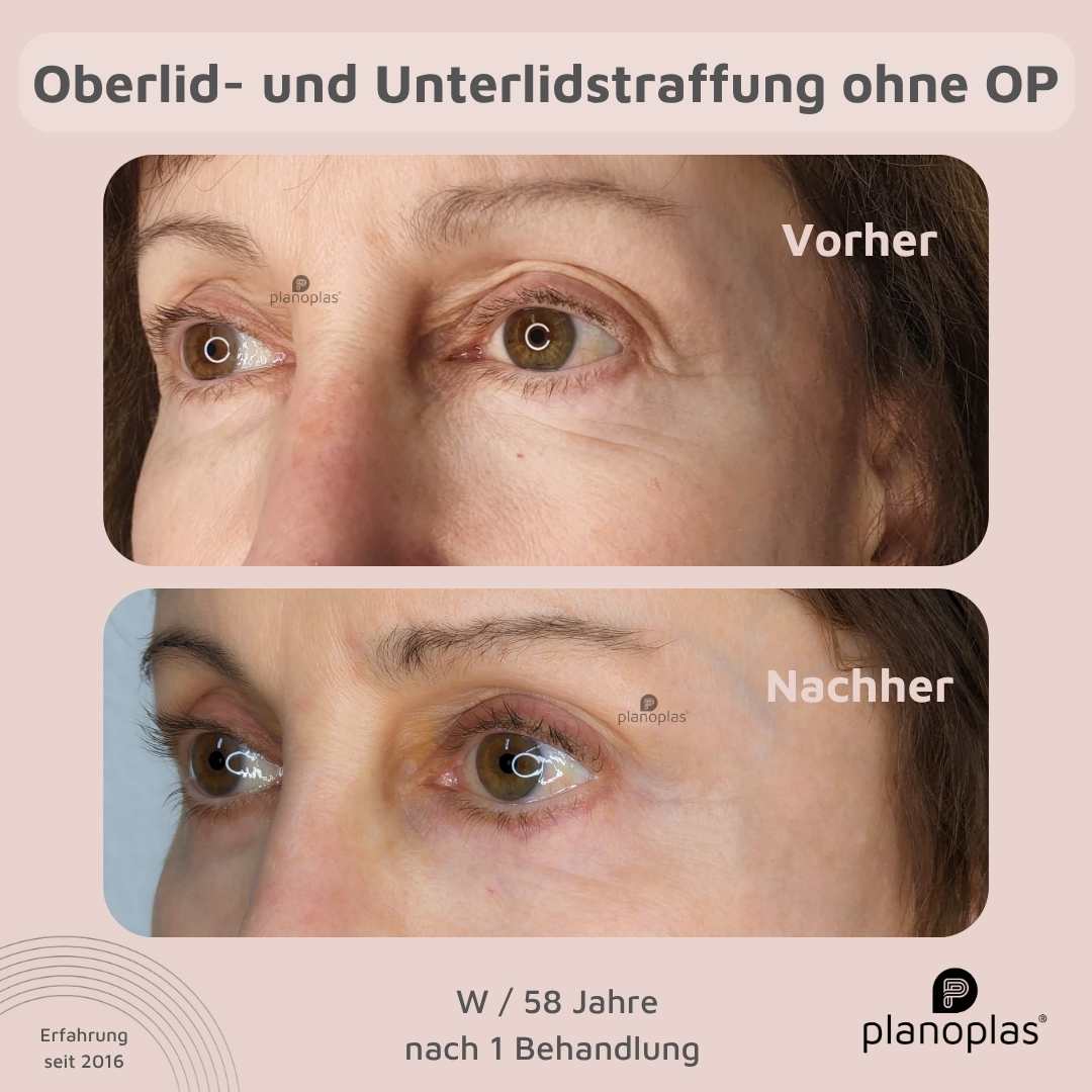 Vorher Nachher Ergebnis Krähenfüße planoplas® Plasma Pen