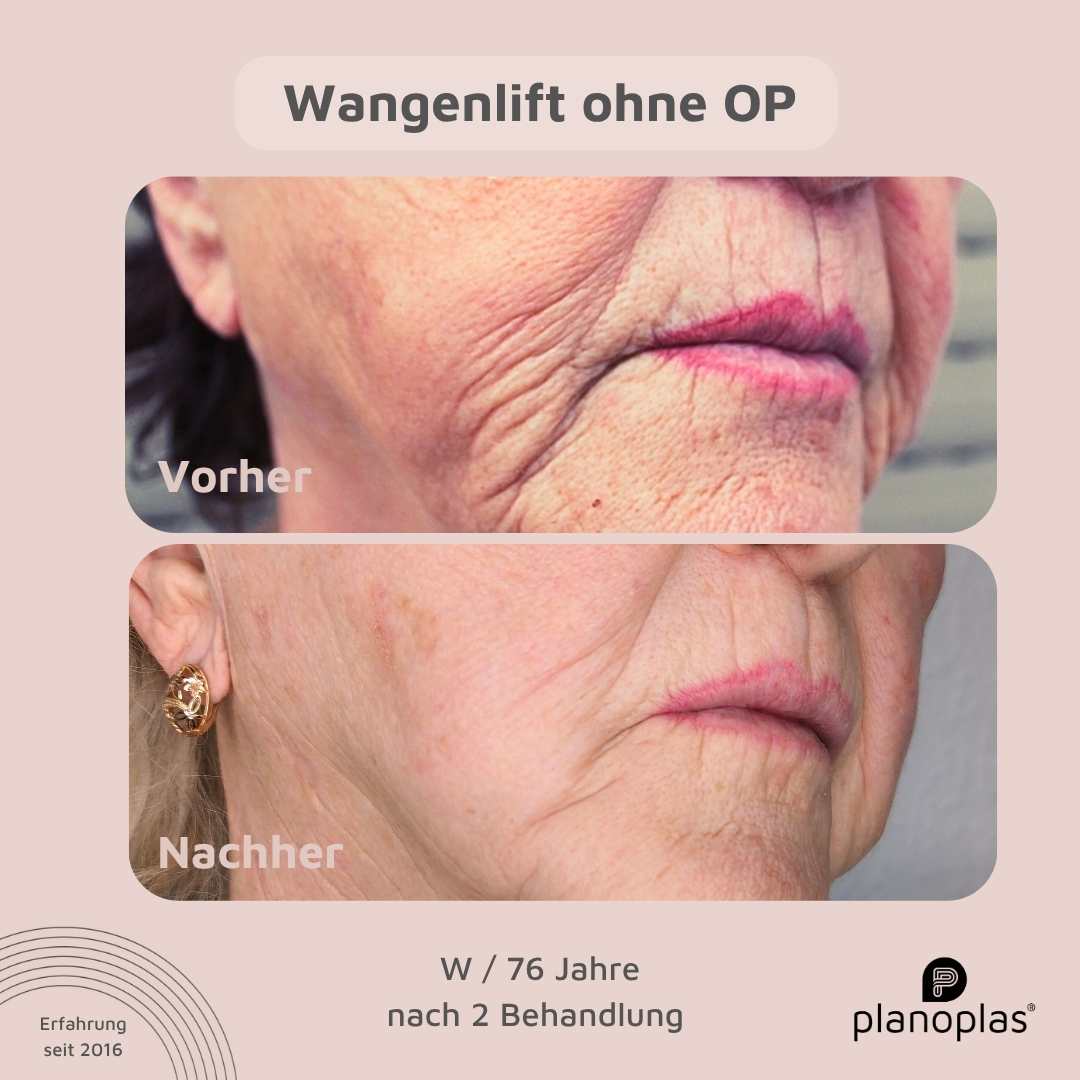 Vorher-Nachher Hautbild planoplas® Plasma Pen