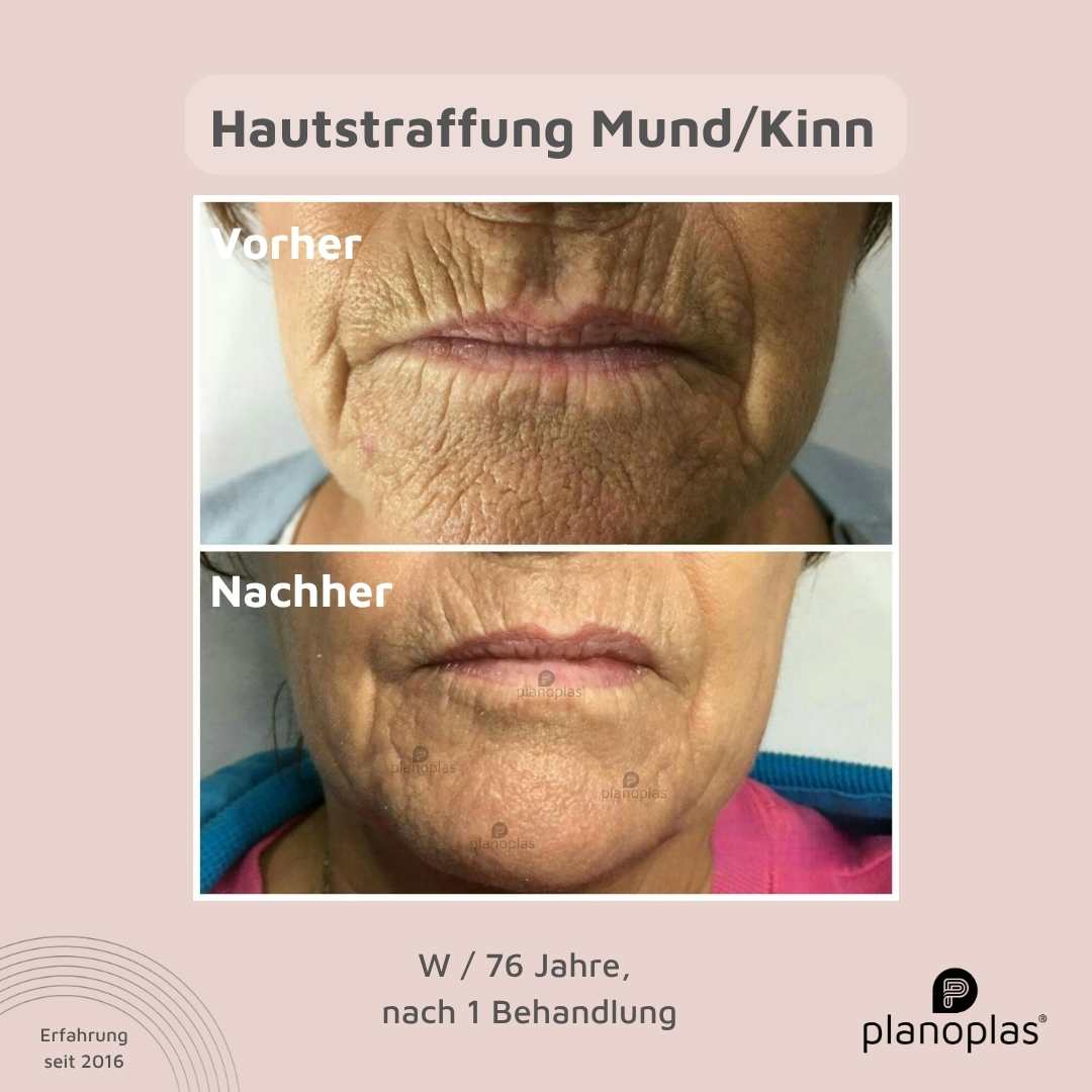 Sichtbare Ergebnisse der planoplas® Plasma Pen Mundbereich Behandlung