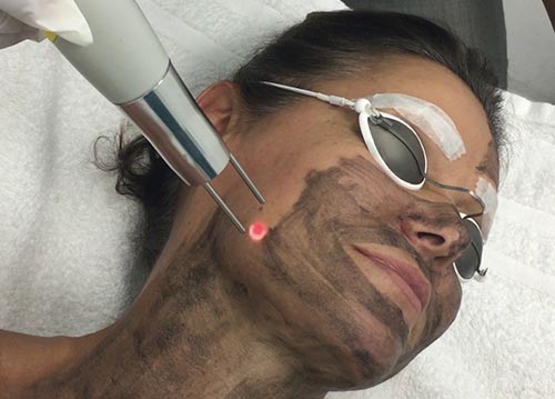 Hollywoodpeeling in Uppsala