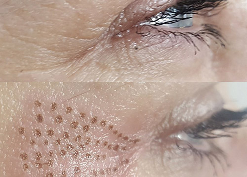 Plasma Pen in Uppsala