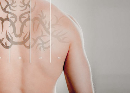 Tatueringsborttagning in Uppsala