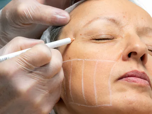 Knivsta Ansiktslyft med Hifu