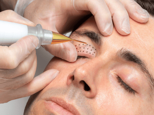 Hårborttagning med laser