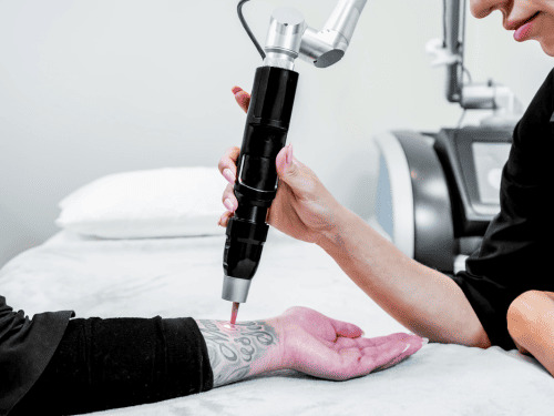 Hårborttagning med laser