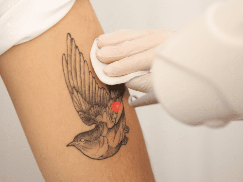 Hårborttagning med laser