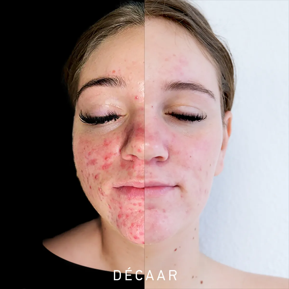 Voor-en-na Algenpeeling: Transformeer je Huid!  Ontdek de kracht van algenpeeling met onze opmerkelijke voor-en-na resultaten. 🌿✨ Op de linkerzijde zie je de huid vóór de algenpeeling, terwijl de rechterzijde het verbluffende resultaat toont na slechts één behandeling. Onze algenpeeling is ontworpen om de huid te verfrissen, poriën te verkleinen en ongewenste onvolkomenheden aan te pakken.  Ervaar zelf de transformatie en herwonnen zelfvertrouwen. 🌟 Maak vandaag nog een afspraak voor een stralende huid! #AlgenPeeling #Huidverzorging #VoorNa #StralendeHuid