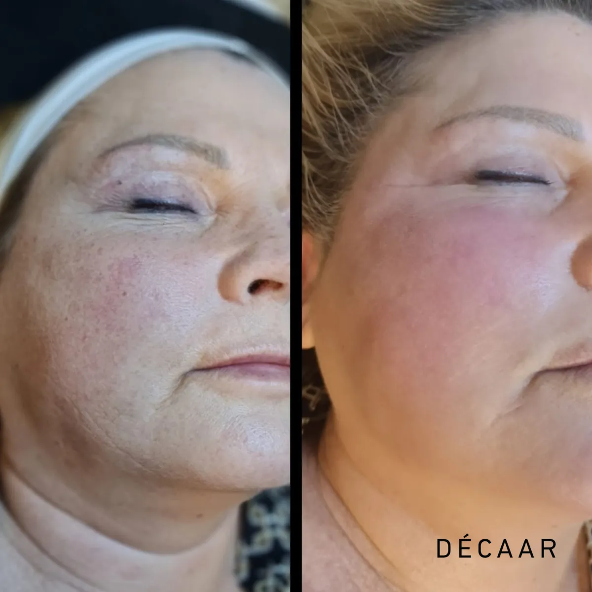 Voor-en-na Algenpeeling: Transformeer je Huid!  Ontdek de kracht van algenpeeling met onze opmerkelijke voor-en-na resultaten. 🌿✨ Op de linkerzijde zie je de huid vóór de algenpeeling, terwijl de rechterzijde het verbluffende resultaat toont na slechts één behandeling. Onze algenpeeling is ontworpen om de huid te verfrissen, poriën te verkleinen en ongewenste onvolkomenheden aan te pakken.  Ervaar zelf de transformatie en herwonnen zelfvertrouwen. 🌟 Maak vandaag nog een afspraak voor een stralende huid! #AlgenPeeling #Huidverzorging #VoorNa #StralendeHuid