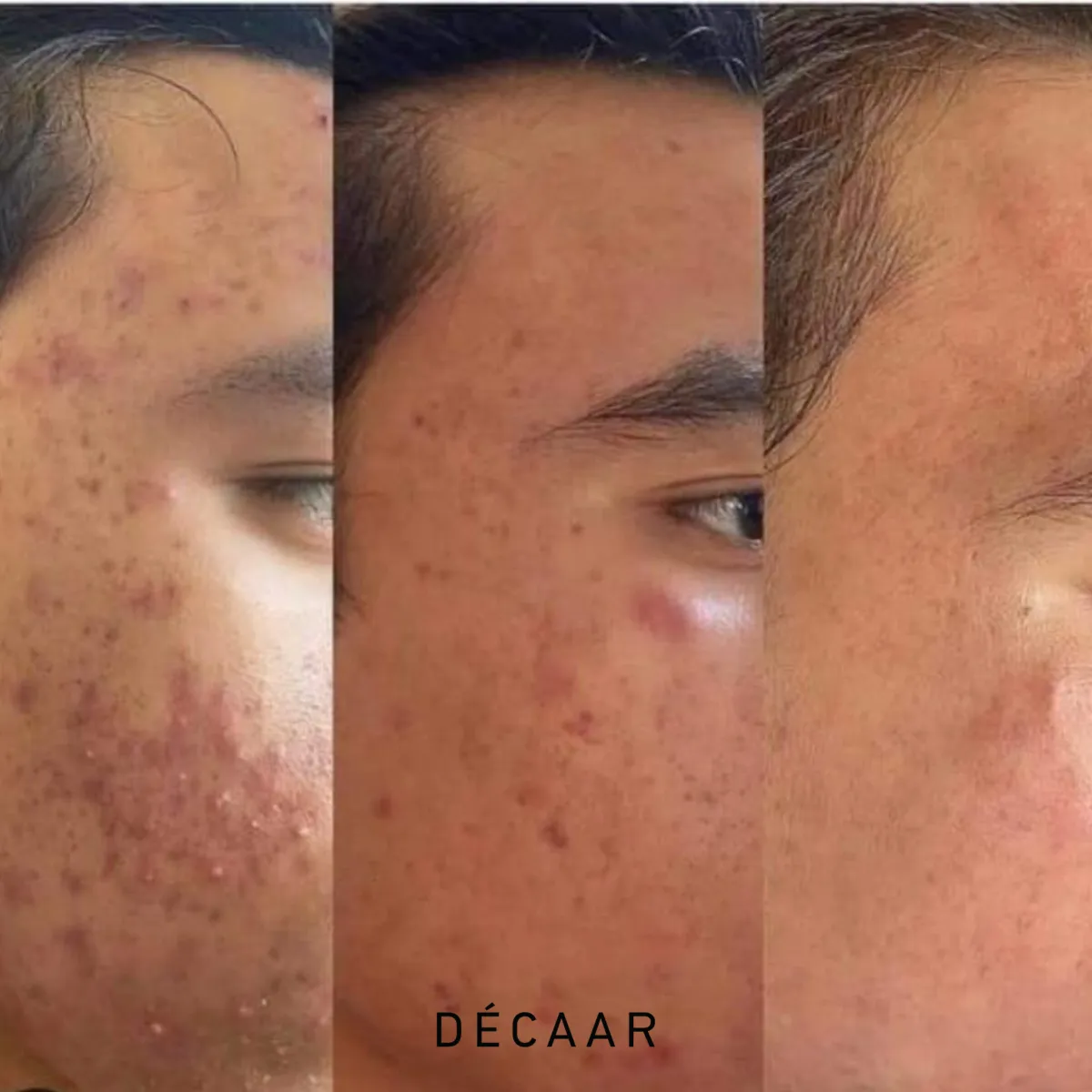 Voor-en-na Algenpeeling: Transformeer je Huid!  Ontdek de kracht van algenpeeling met onze opmerkelijke voor-en-na resultaten. 🌿✨ Op de linkerzijde zie je de huid vóór de algenpeeling, terwijl de rechterzijde het verbluffende resultaat toont na slechts één behandeling. Onze algenpeeling is ontworpen om de huid te verfrissen, poriën te verkleinen en ongewenste onvolkomenheden aan te pakken.  Ervaar zelf de transformatie en herwonnen zelfvertrouwen. 🌟 Maak vandaag nog een afspraak voor een stralende huid! #AlgenPeeling #Huidverzorging #VoorNa #StralendeHuid