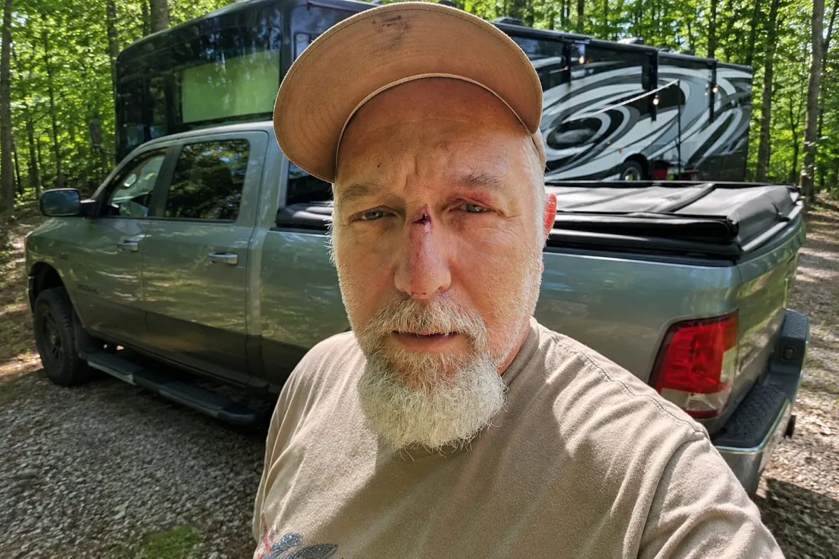 I Got Hit in the Face at the Bar…