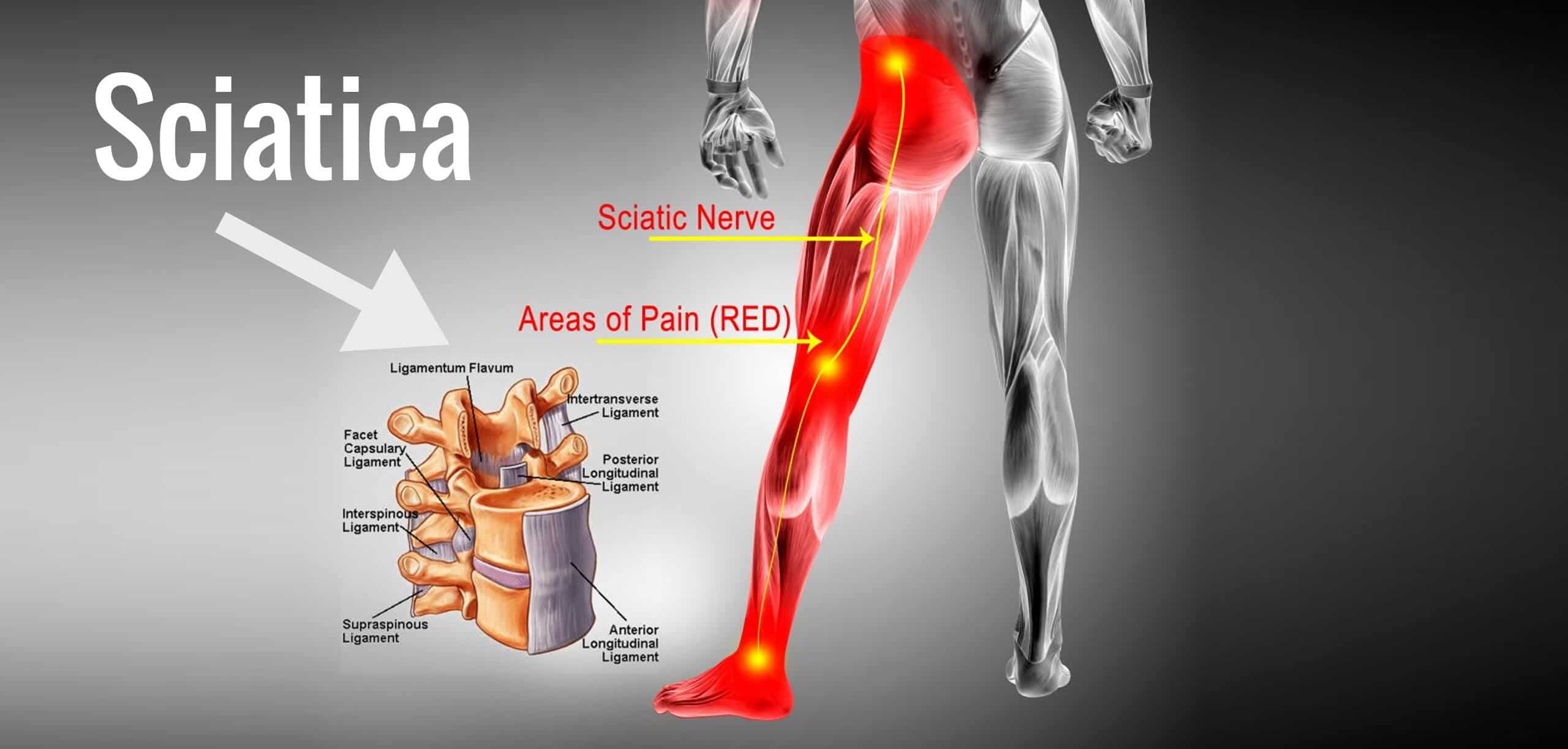 Sciatica