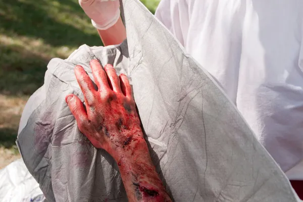 Burn Injuries on the Job: Your Right to Compensation