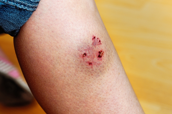 Dog Bite Liability in Idaho: What Victims Should Know
