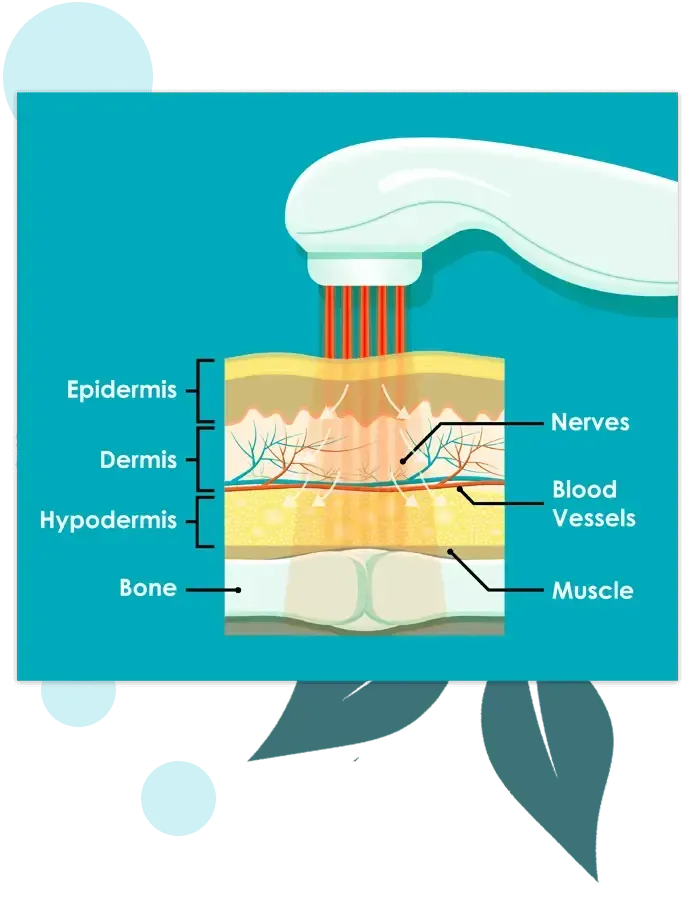 Cold Laser Therapy Lawrenceville Georgia