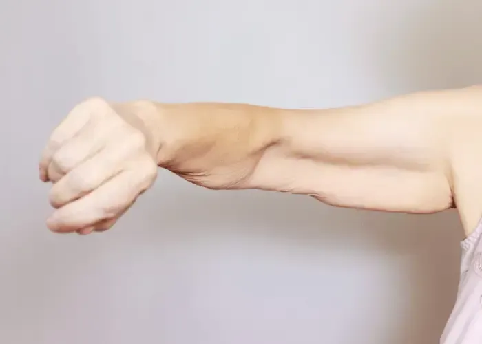 An arm with noticeable muscle loss in Gainesville Georgia.