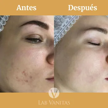 Resultados del tratamiento peeling láser en Lab Vanitas