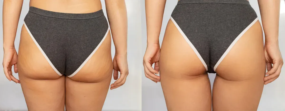 T-Shape 2 legs and buttocks before and after treatment series