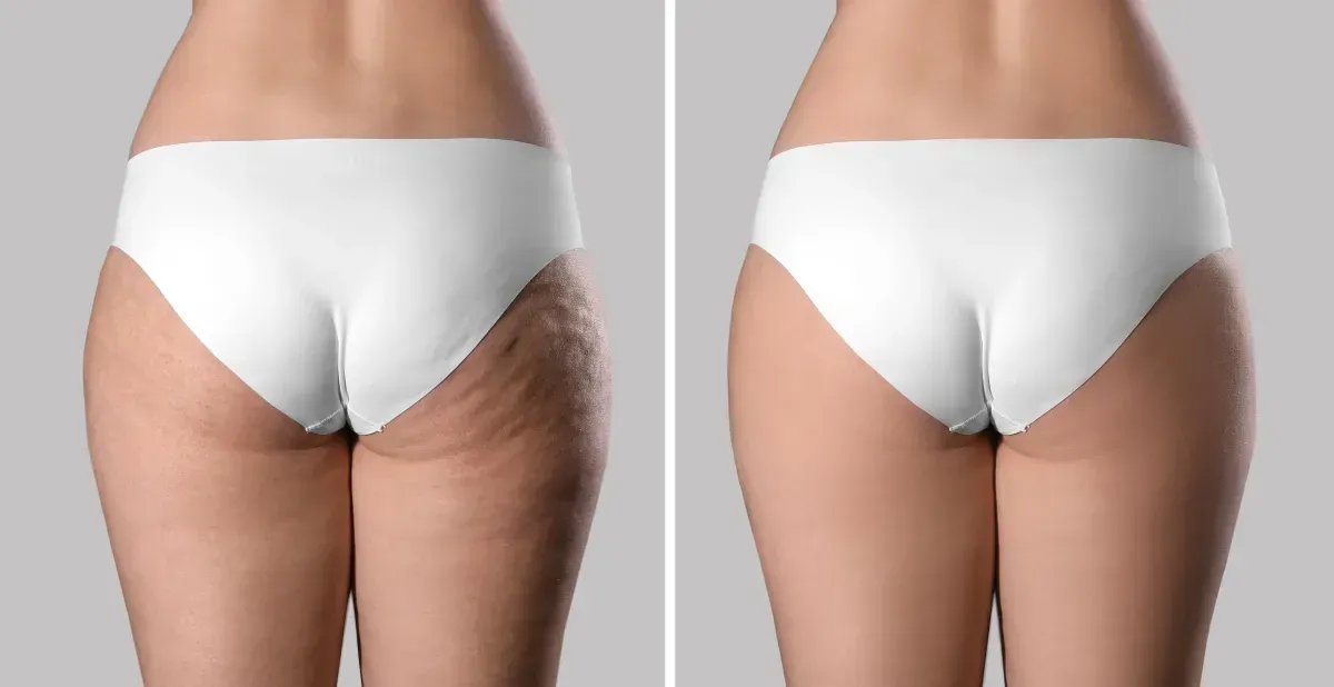 T-Shape 2 buttocks before and after treatment series