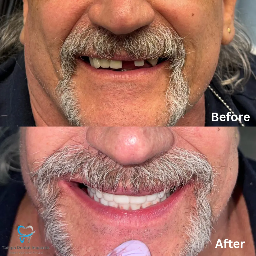 Smile Makeovers