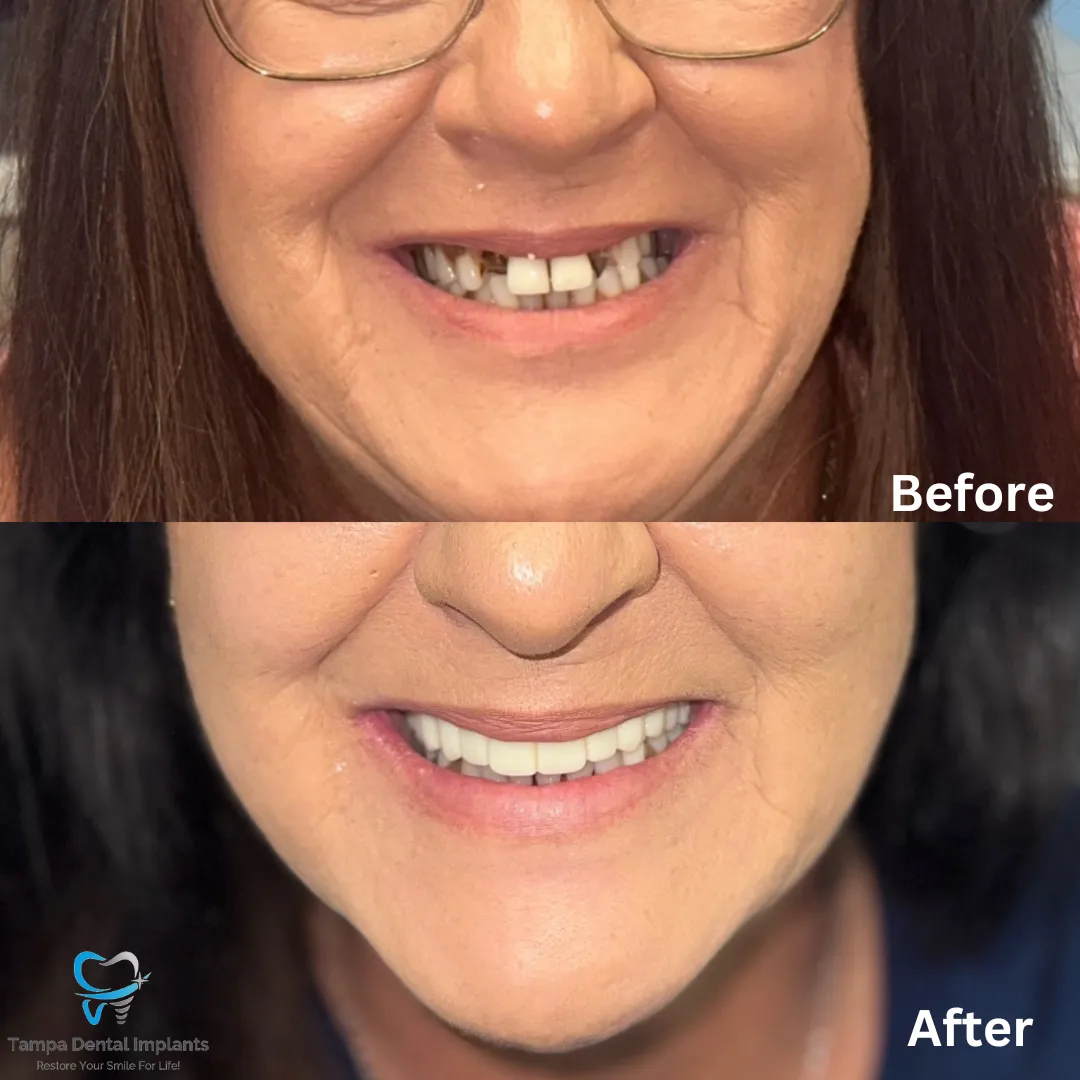 Full Arch Implant