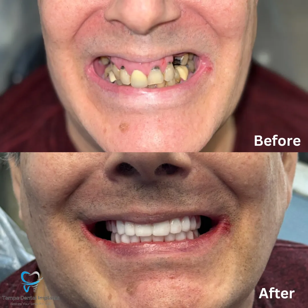 Snap on Dentures