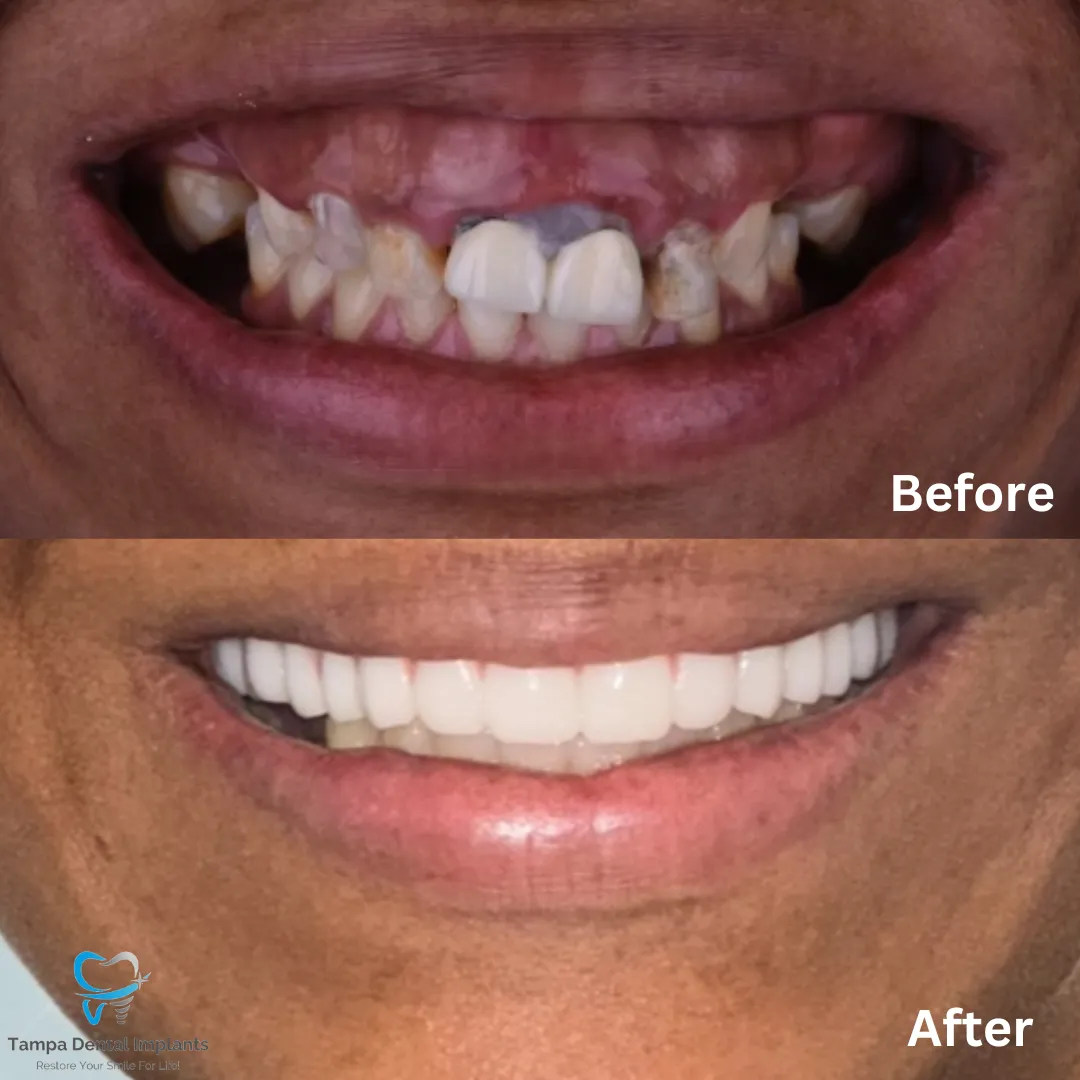 Fixed Dentures