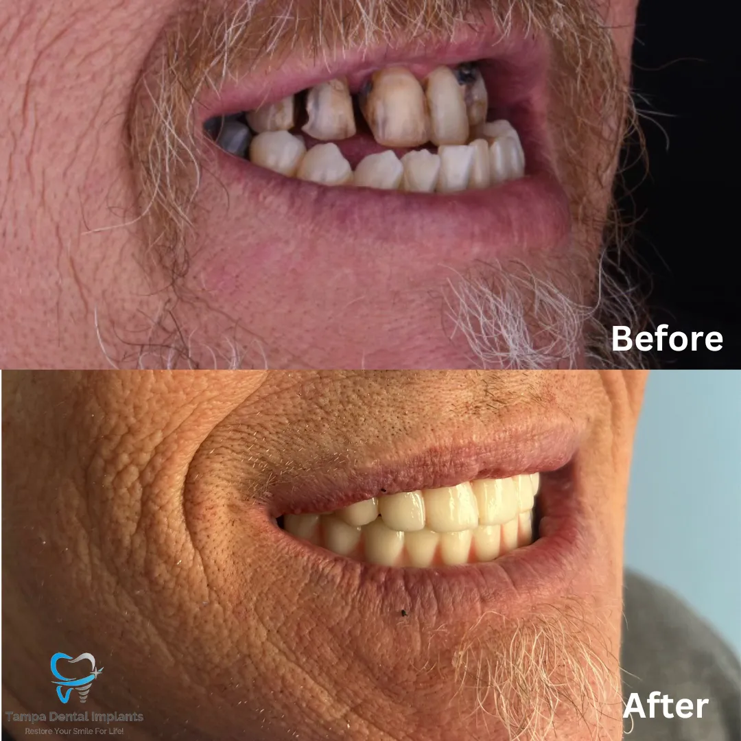 Permanent Implants