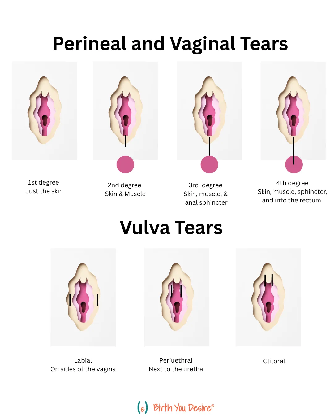 Perineal Tears