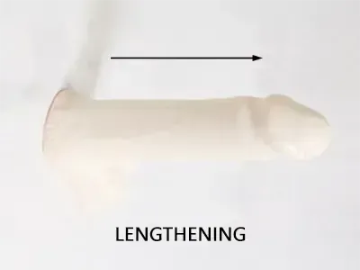 Chin an Neck Liposuction