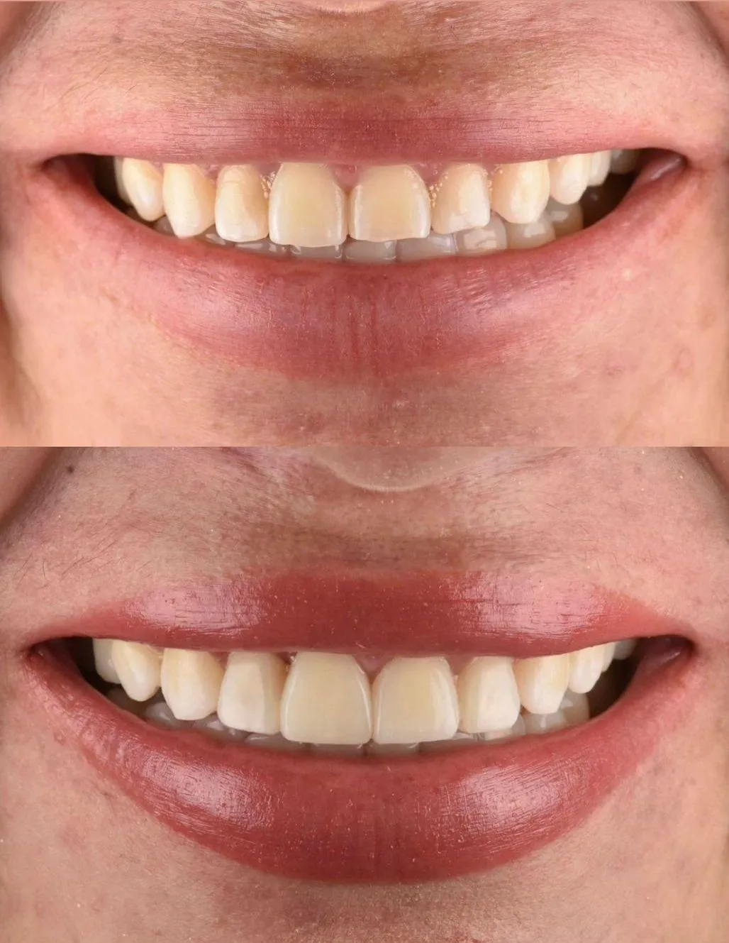 Resultado de paciente - Lifting Facial