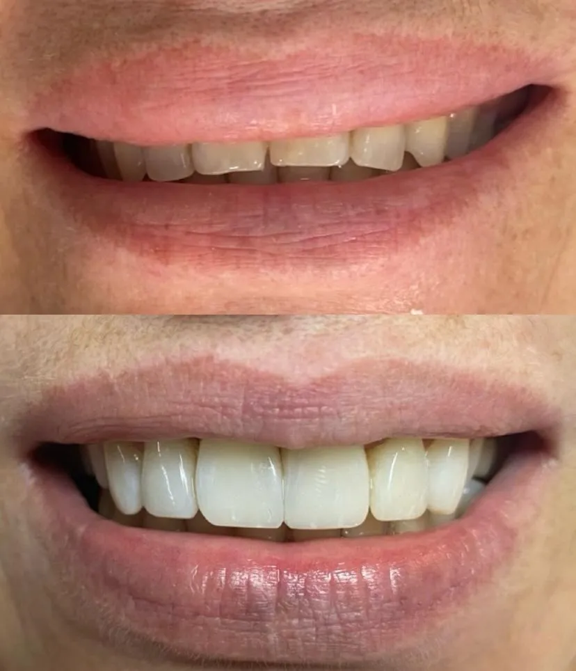 Resultado de paciente - Abdominoplastia