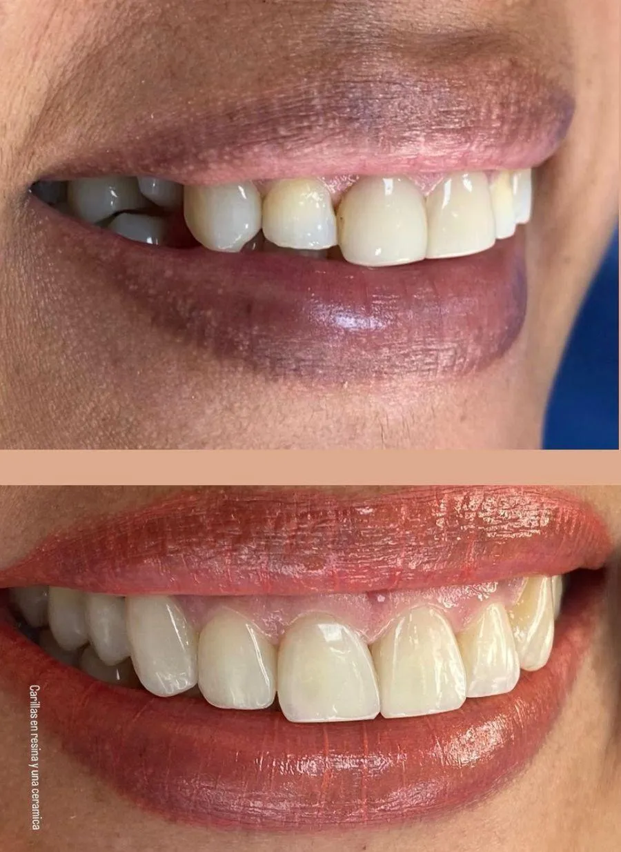 Resultado de paciente - Blefaroplastia