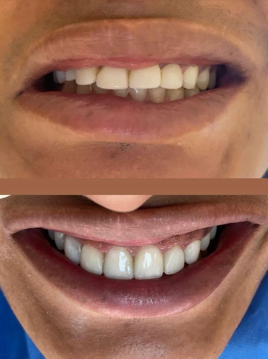 Resultado de paciente - Mamoplastia