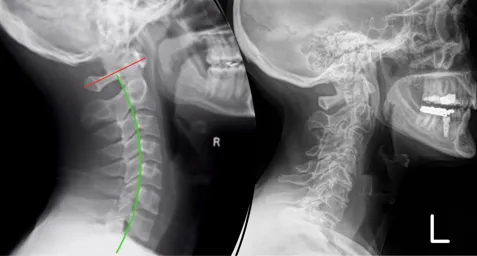 greyscale photography of skeleton