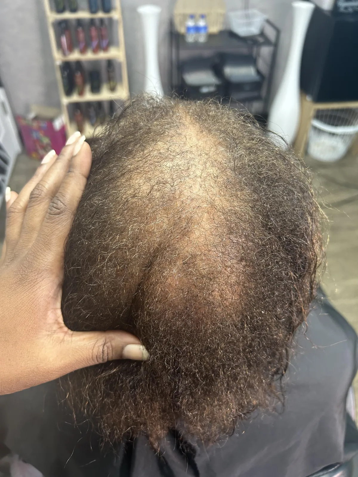 DHT Blockers; Thinning hair; Hair Re-growth
