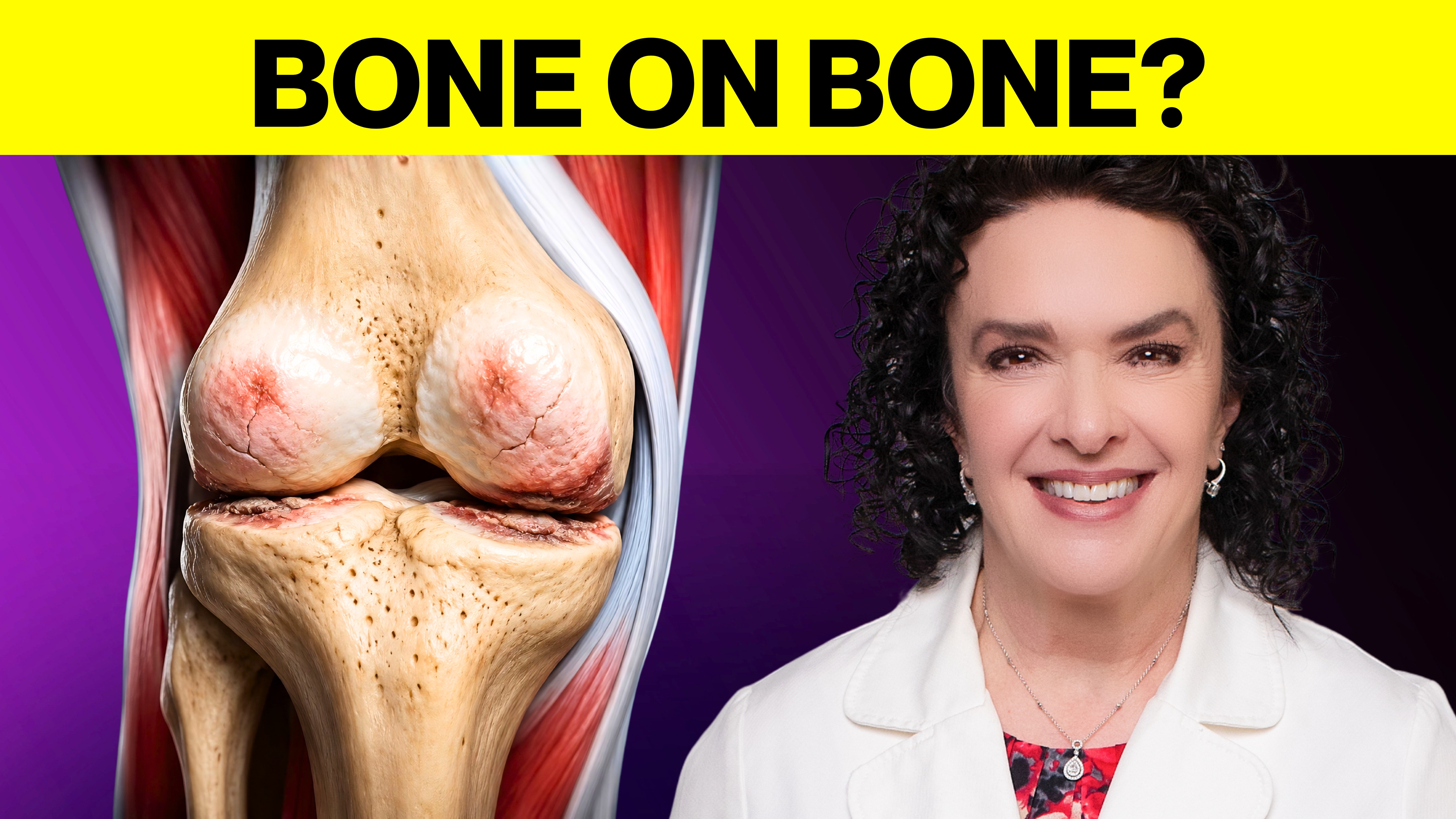 What "Bone on Bone" Actually Means, and Why It Is Not the End of the Conversation